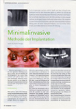 Minimalinvasive Methode der Implantation