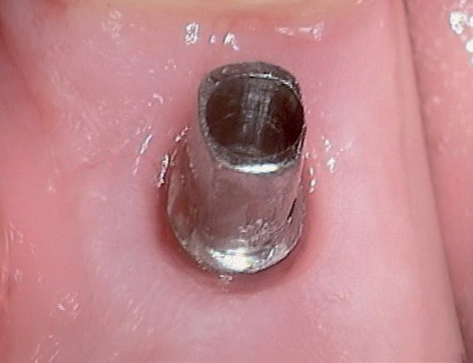 MIMI®-Flapless: in rund 98 % keine Implantat-Freilegung oder Wiedereröffnung der Gingiva